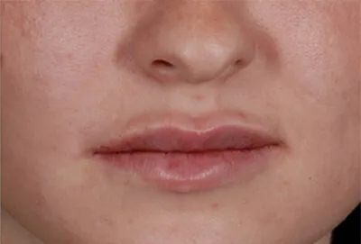 After result of Lip Filler | Lifestyle's MedSpa