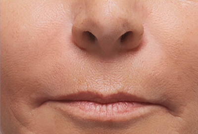 After Lip Filler Treatment